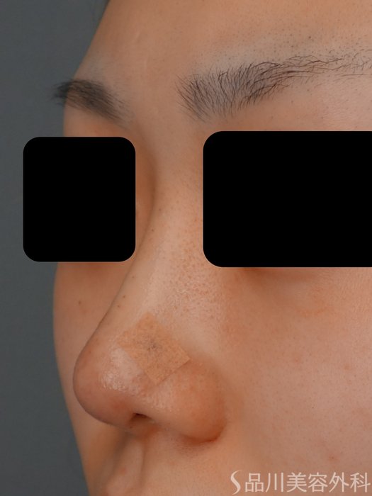 症例NO.73593のAFTER写真