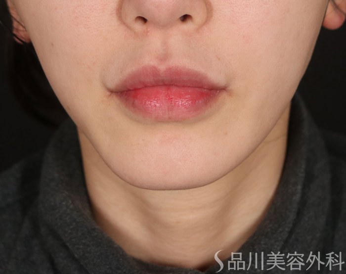 症例NO.73420のBEFORE写真