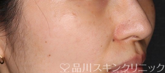 症例NO.74226のAFTER写真