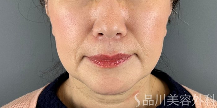 症例NO.70684のBEFORE写真