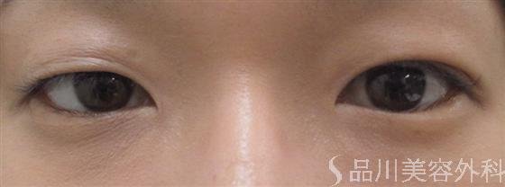 症例NO.18110のBEFORE写真