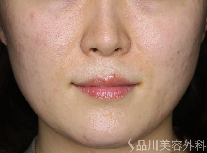 症例NO.70771のBEFORE写真