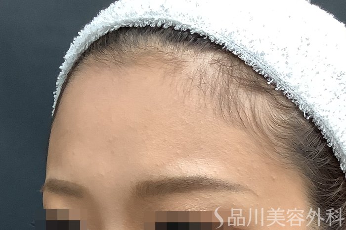 症例NO.67799のBEFORE写真