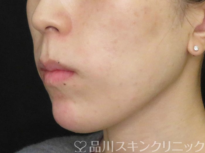 症例NO.65518のAFTER写真