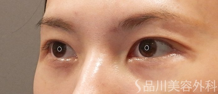症例NO.71728のAFTER写真