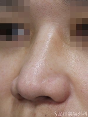 症例NO.75045のBEFORE写真