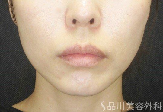 症例NO.69089のBEFORE写真