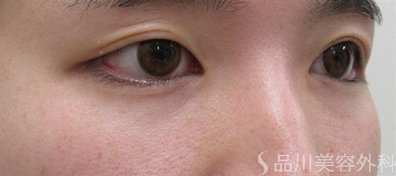 症例NO.35855のBEFORE写真