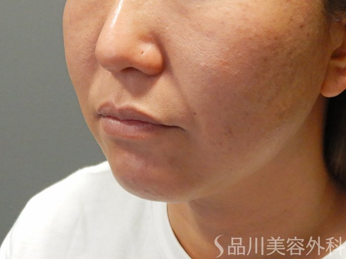 症例NO.69929のBEFORE写真