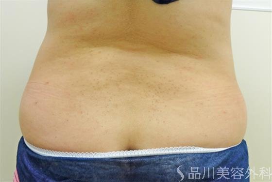 症例NO.23717のAFTER写真