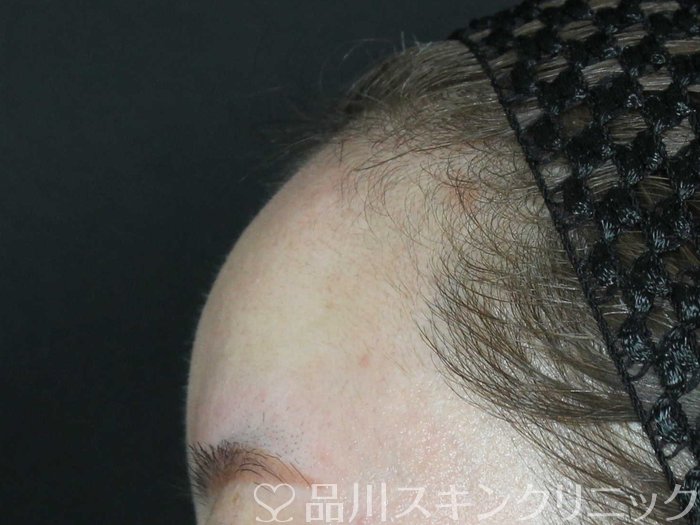 症例NO.70235のBEFORE写真