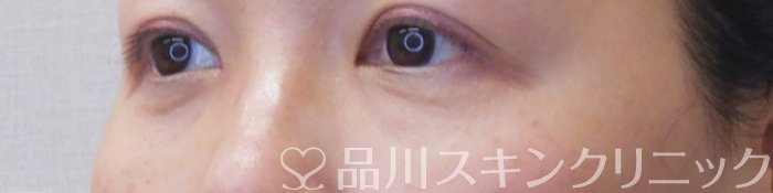 症例NO.71660のAFTER写真