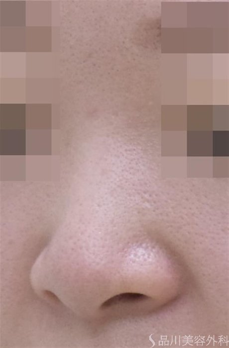 症例NO.48541のBEFORE写真