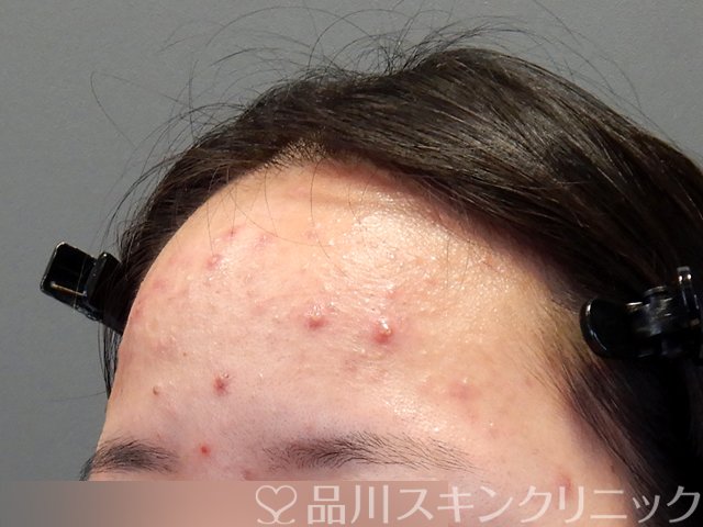 症例NO.69797のBEFORE写真