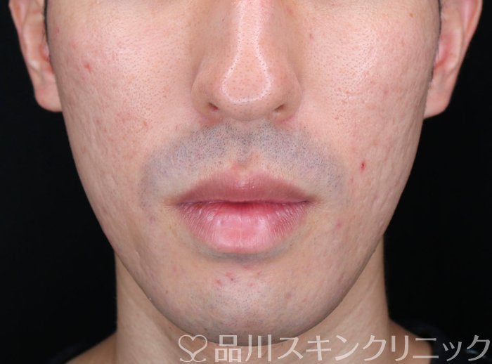 症例NO.72557のAFTER写真