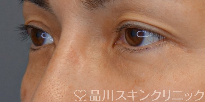 症例NO.71007のBEFORE写真