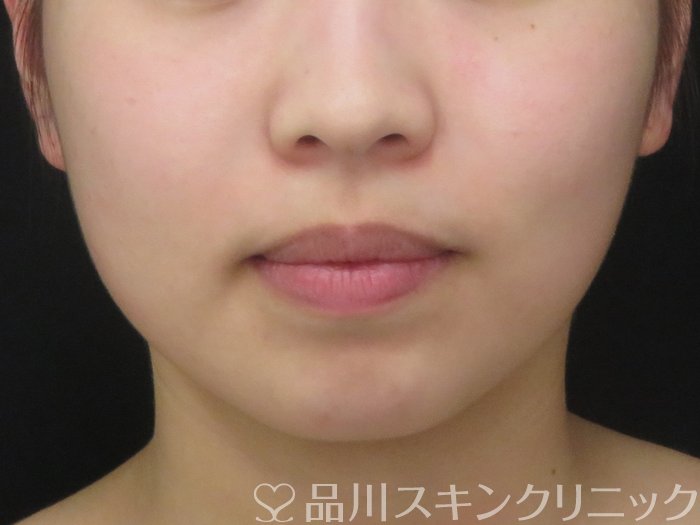 症例NO.69472のBEFORE写真