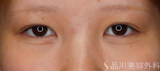 症例NO.55608のAFTER写真