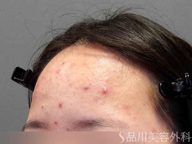 症例NO.69797のBEFORE写真