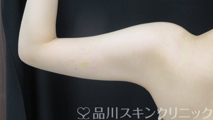 症例NO.70884のBEFORE写真