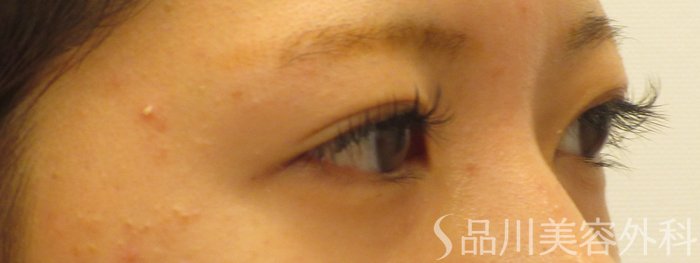 症例NO.72017のBEFORE写真