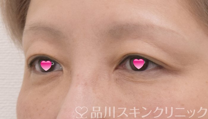 症例NO.74272のBEFORE写真