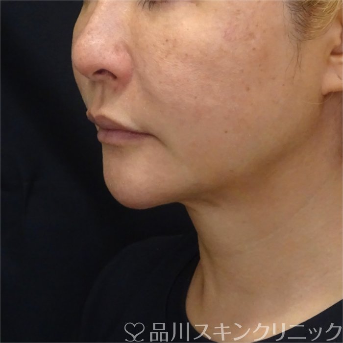 症例NO.72387のBEFORE写真