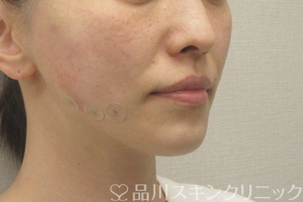 症例NO.74647のAFTER写真