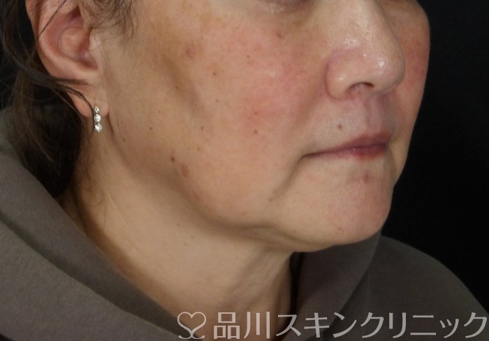 症例NO.72608のBEFORE写真