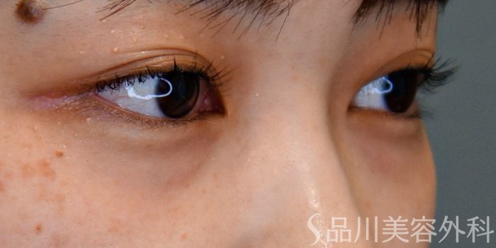 症例NO.69751のBEFORE写真