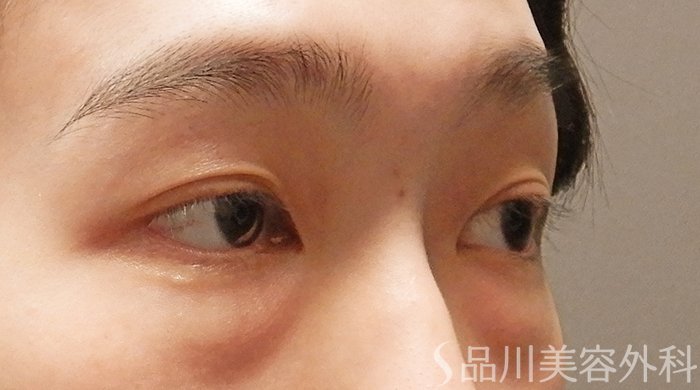 症例NO.69304のBEFORE写真