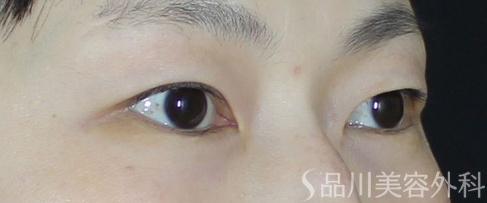 症例NO.70594のBEFORE写真