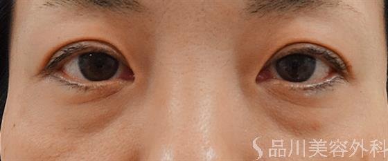 症例NO.25955のBEFORE写真