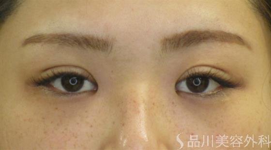 症例NO.58056のAFTER写真