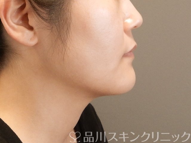 症例NO.65671のAFTER写真