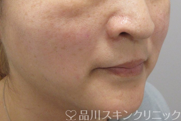 症例NO.70581のAFTER写真