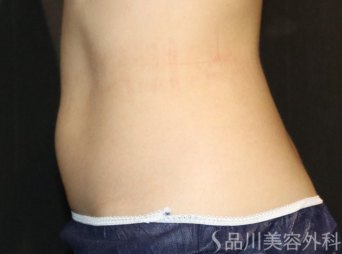 症例NO.75261のAFTER写真
