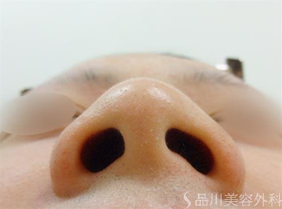 症例NO.23230のBEFORE写真