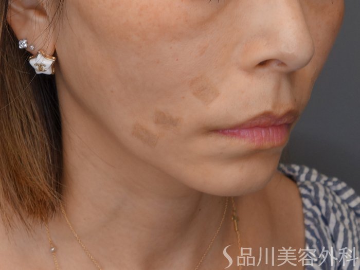 症例NO.71205のAFTER写真