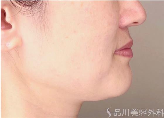 症例NO.50080のBEFORE写真