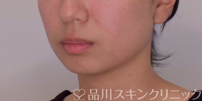 症例NO.67764のBEFORE写真