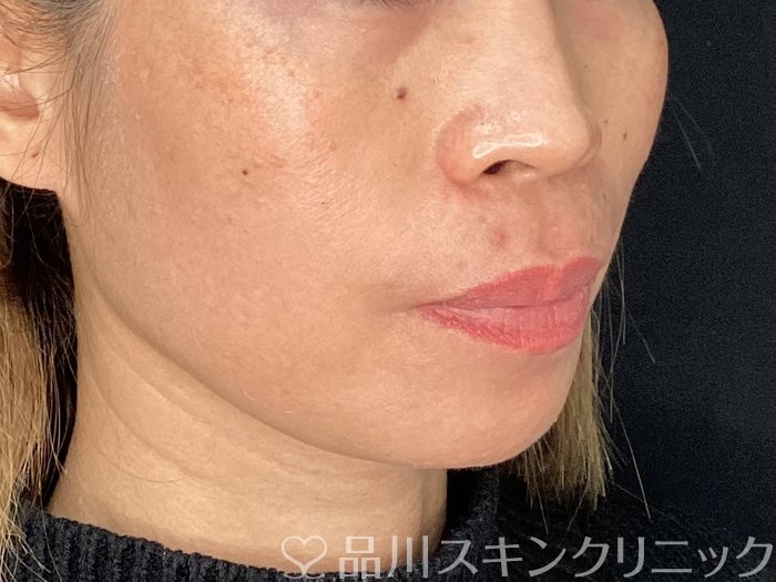 症例NO.72661のBEFORE写真