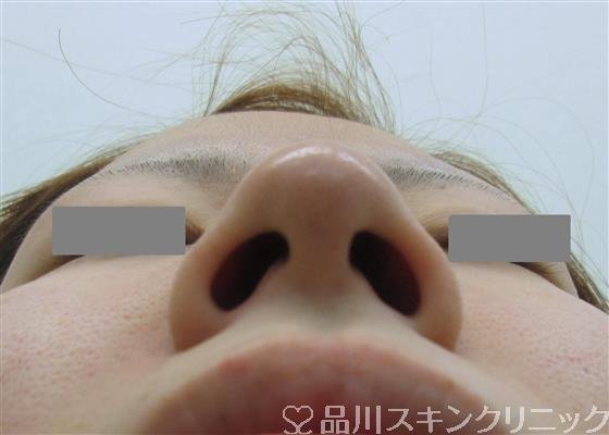 症例NO.32394のBEFORE写真