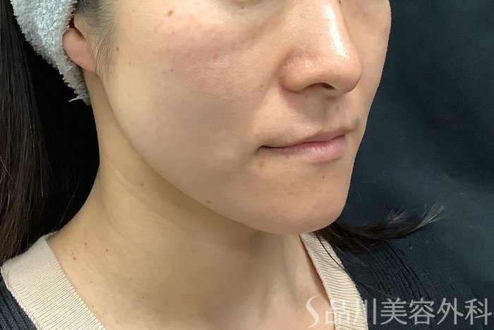 症例NO.71545のBEFORE写真
