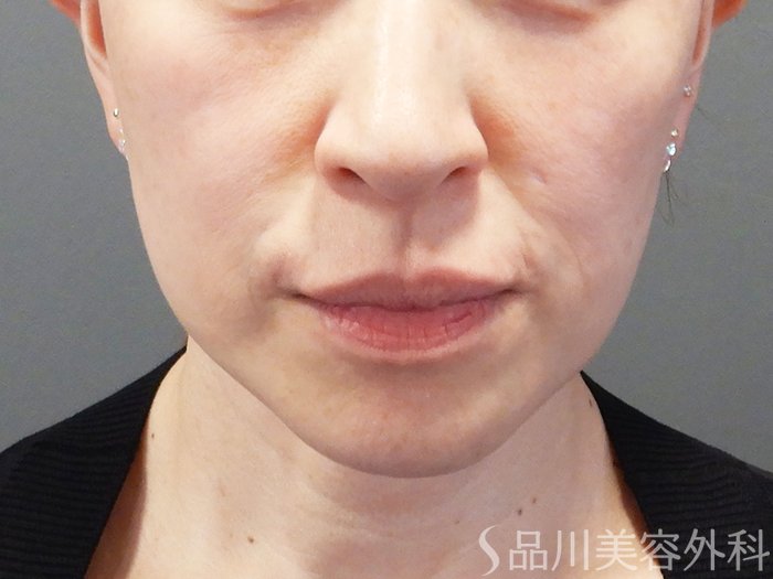症例NO.74626のBEFORE写真