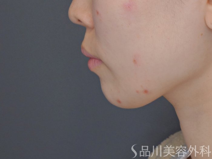 症例NO.72317のBEFORE写真