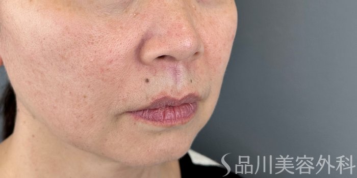 症例NO.67951のBEFORE写真