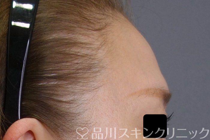 症例NO.74587のBEFORE写真