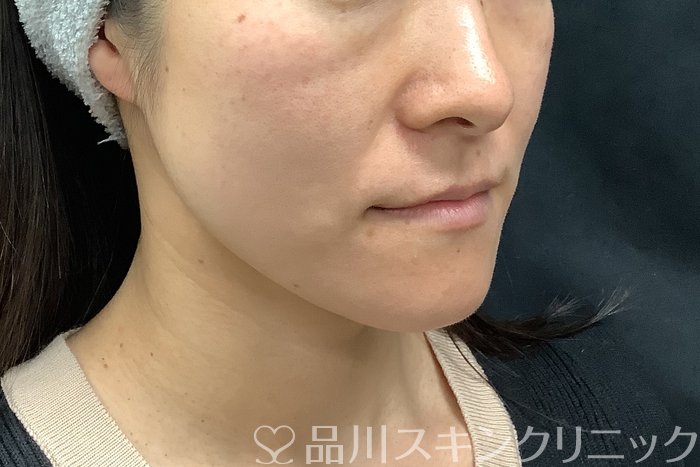 症例NO.71545のBEFORE写真