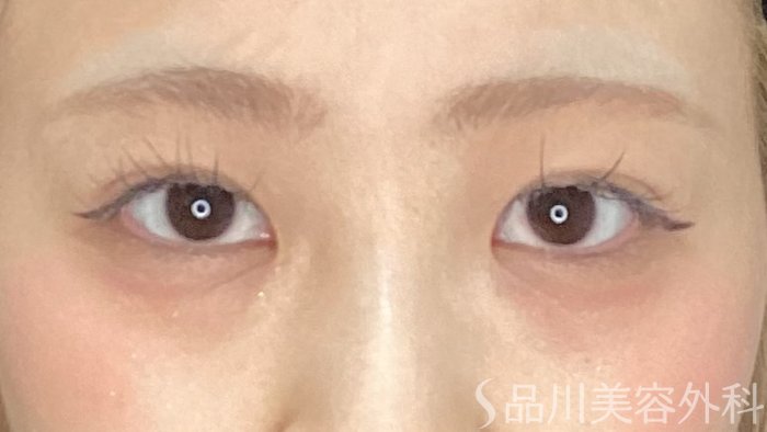 症例NO.71360のAFTER写真